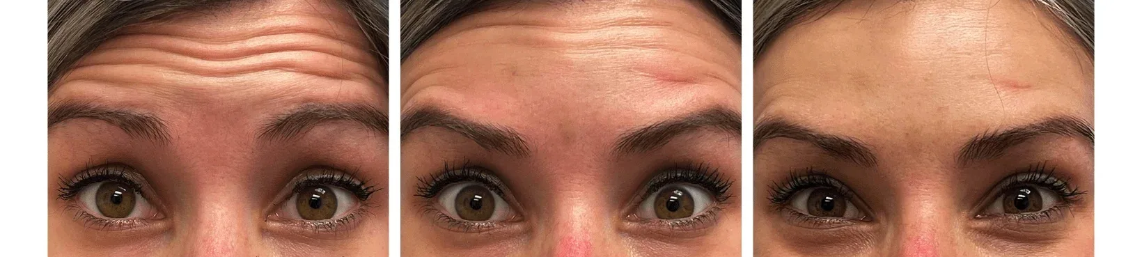 Toxinbeforeafter1 4Da6C333 - Botoderm